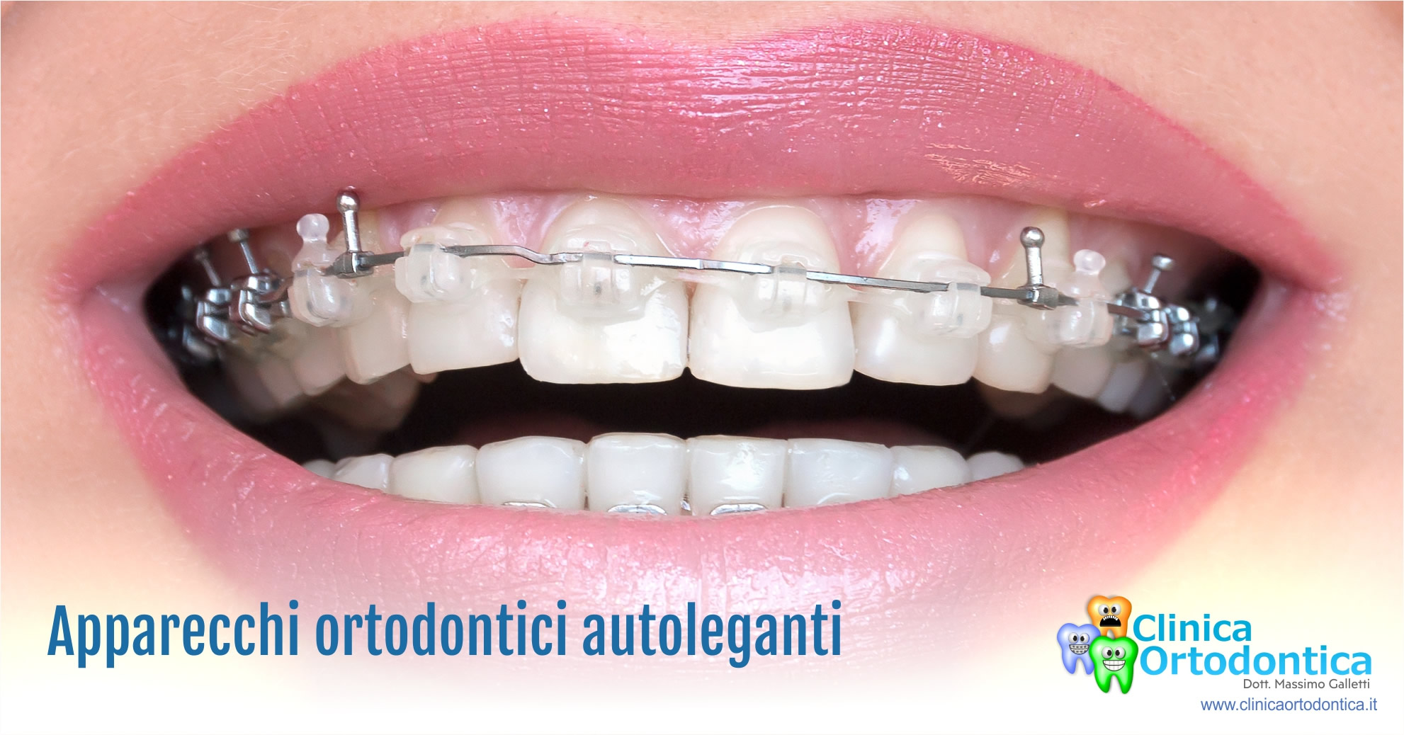 http://www.clinicaortodontica.it/public/trattamento-ortodontico-a-Palermo-con-apparecchi-ortodontici-autoleganti.jpg