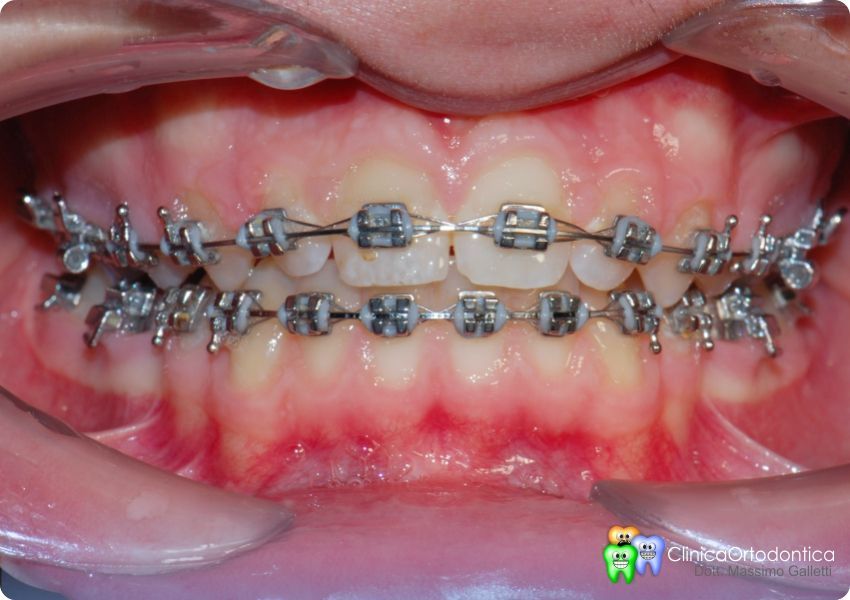 Apparecchi ortodontici autoleganti, Clinica Ortodontica del Dott. Massimo  Galletti